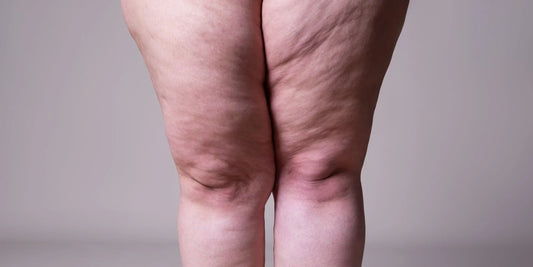 Tengo lipedema